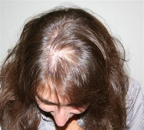 Pin On Hair Loss Treatment