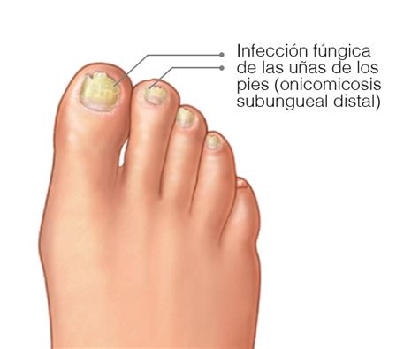 Las 96 Mejores Se Curan Los Hongos De Las Uñas De Los Pies Spdamri