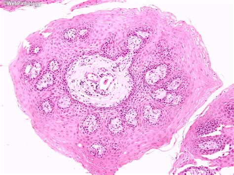 Squamous Papilloma Pharynx How Long Does Hpv Throat Cancer Take To Riset