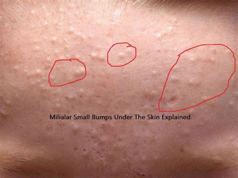 Milialar Small Bumps Under The Skin Explained Sukıtır