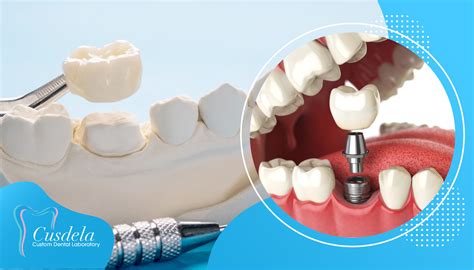 Dental Implant Vs Crown Pros And Cons Blog