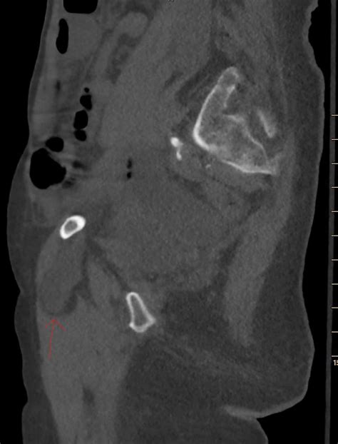 Cureus Asynchronous Bilateral Obturator Hernias A Suggested Approach