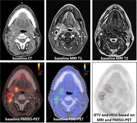 The Utility Of Multiparametric Mri To Characterize Hypoxic Tumor