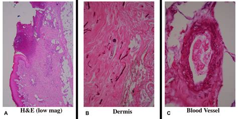 Histologic Findings Of Skin Biopsy Sections Obtained From Local