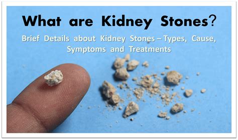 Best Ayurvedic Treatment For Kidney Stone Removal