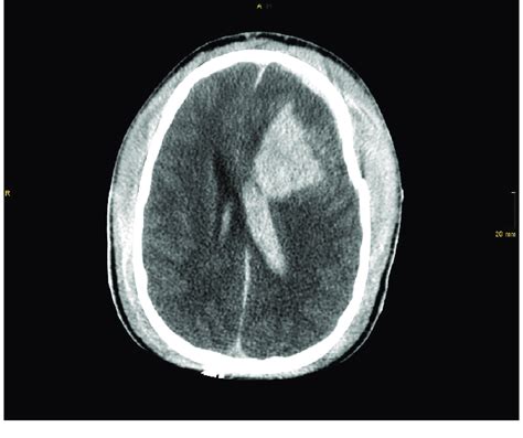 Severe Traumatic Brain Injury With Skull Impression Intraventricular