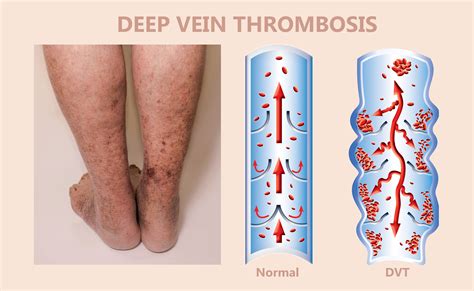 Deep Vein Thrombosis What Is It Causes Prevention And More Osmosis Hot Sex Picture