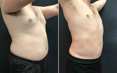 Vaser Lipo For Male Belly And Love Handles