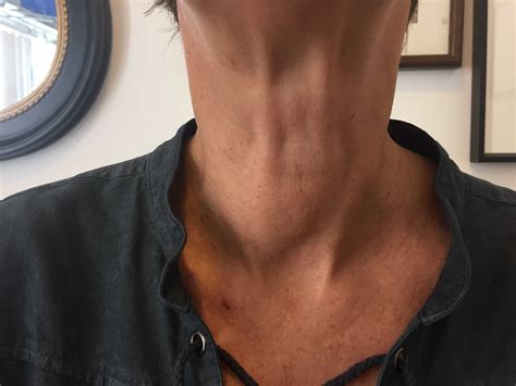 Is This What Your Neck Looks Like Is The Goiter Giving You Symptoms