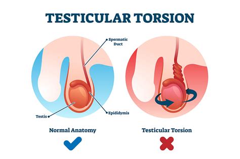 Testicular Torsion What All Men And Boys Should Know Queensland Health