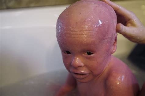 Boy 5 Has Skin That Grows 10 Times Normal Rate Leaving Him With