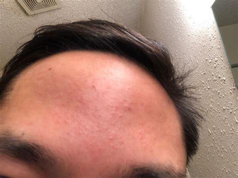 Forehead Bumps Will Not Go Away Affecting Confidence For Work Over