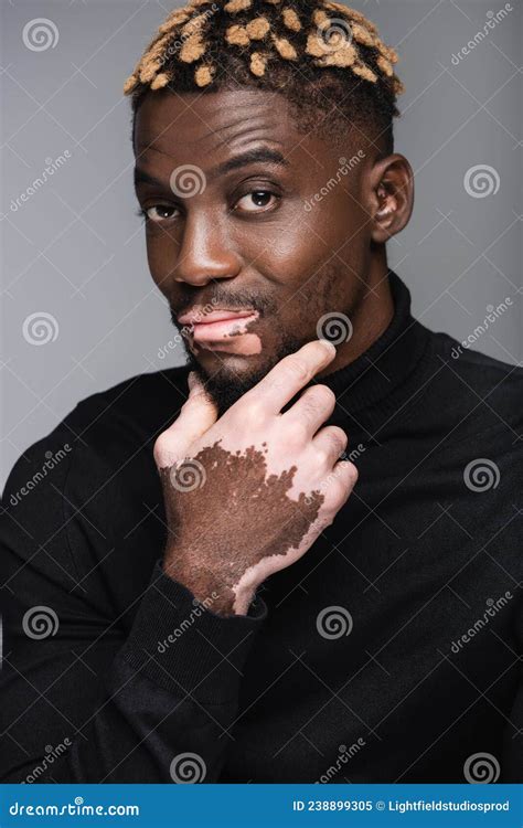 Thoughtful African American Man With Vitiligo Stock Image Image Of