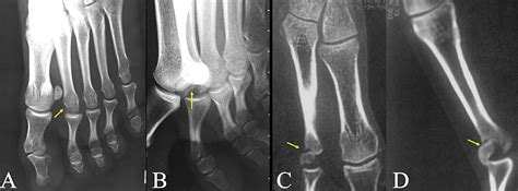 Cureus Acute Osteochondral Fracture Of The Metatarsal Head A Report Of Two Cases And Review