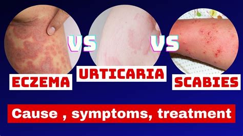 Eczema Vs Urticaria Vs Scabies Eczema Urticaria Scabies Skin