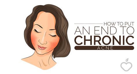 How To Put An End To Chronic Acne Positive Health Wellness