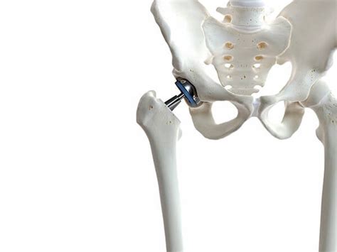 Dr Michael Mcauliffe Orthopaedic Surgeon Knee Hip And Lower Limb