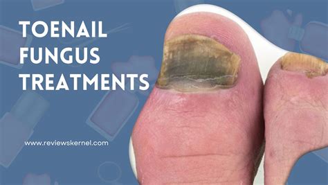 Best Toenail Fungus Treatments Say Goodbye To Fungal Woes