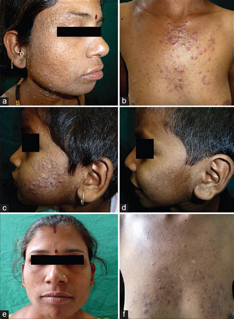 Three Cases Of Suspected Chloracne In A Family From Pune Indian Journal Of Dermatology