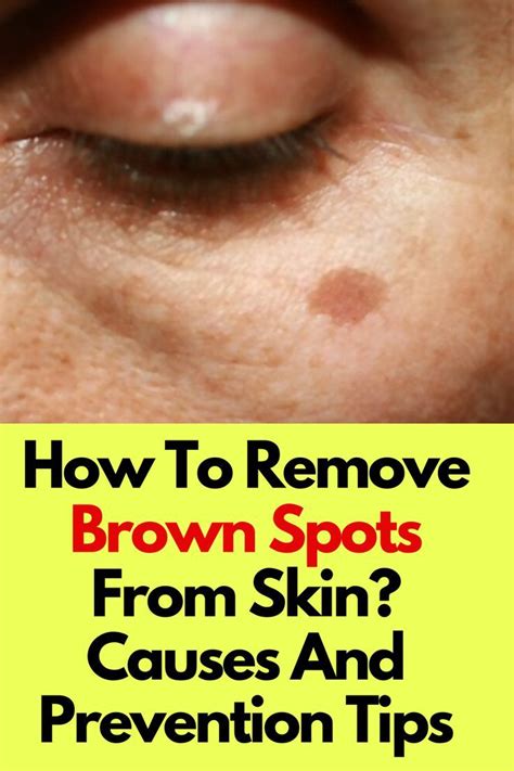 How To Remove Brown Spots From Skin Causes And Prevention Tips Brown