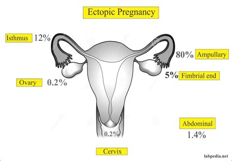 Ectopic Pregnancy And Its Diagnosis Labpedia Net