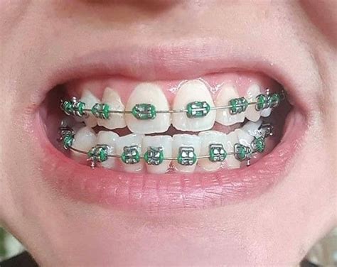Pin By John Beeson On Orthodontic Braces Braces Tips Orthodontics Orthodontics Braces