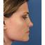 Healing After Closed Rhinoplasty Nosejob In San Diego By Nose 