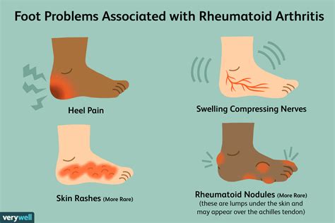 Joint Pain In The Feet A Symptom Of Rheumatoid Arthritis