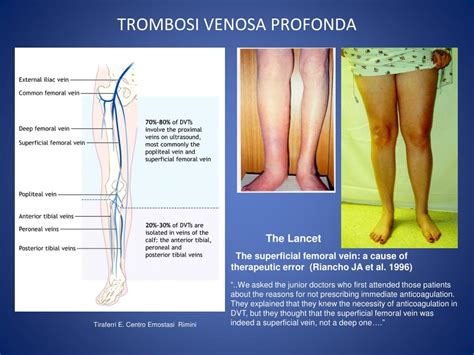 L'embolia polmonare (ep) è l'ostruzione acuta (completa o parziale) di uno o più rami dell'arteria polmonare da parte di materiale in questo caso si parla di embolia polmonare non massiva. PPT - Trombosi Venosa Profonda Il sospetto clinico ...