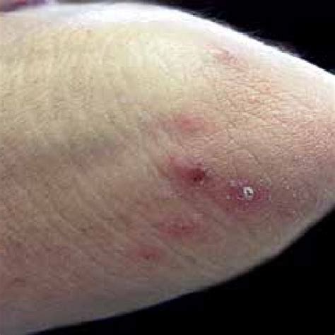 Erythematous Purpuric Papules On The Dorsum Of The Left Hand
