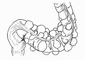 This pressure makes them bulge out, making little pouches. Diverticulosis - Wikipedia