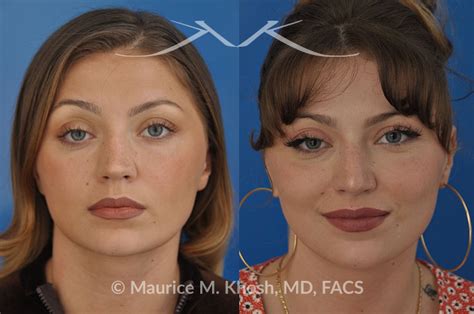 New York Facial Plastic Surgery Saddle Nose Repair Before And After