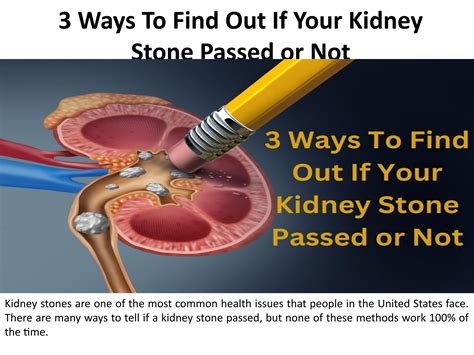 How To Find Out If A Kidney Stone Has Passed By Nephro Urology Center