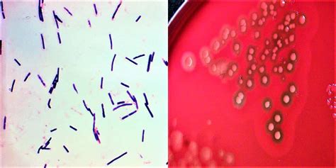 Clostridium Perfringens Okozta ételmérgezés Orvos 24