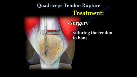 Quadriceps Tendon Rupture Everything You Need To Know Nabil