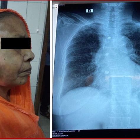 Patient With Right Parotid Gland Swelling A Chest X Ray