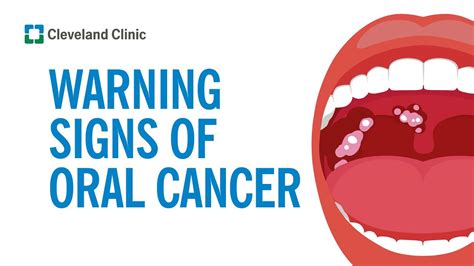 How To Screen Yourself For Oral Cancer Youtube