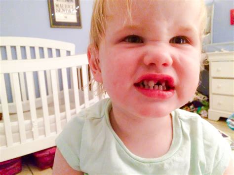 3) possibly, most likely not. Two year-old knocked out front tooth...please tell me ...