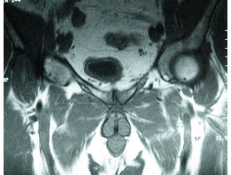 Mri Of The Pelvis Pubic Symphysitis With Inflammatory Aspect Of The