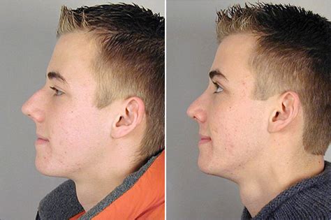 Some men who undergo nose reshaping prefer to maintain a masculine appearance of the nose including having a straight profile and not raising the tip above 90 degrees. Male Rhinoplasty Patient 1 - Parker Center for Plastic Surgery