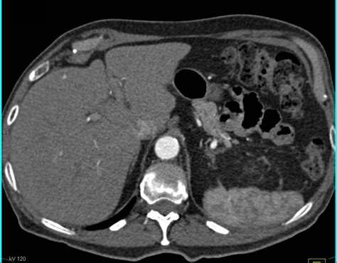 Renal Cell Carcinoma With Lung Metastases Kidney Case Studies