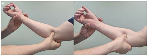 Jcm Free Full Text Proximal Median Nerve Compression In The