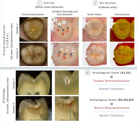 Study Finds Trios 4 Caries Detection On Par With Clinical Visual