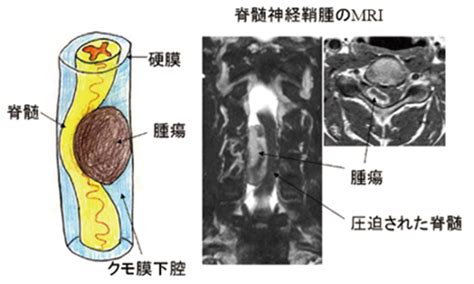 腫瘍の種類によって、薬の種類や投与期間も異なりますので、よく専門の先生と相談してください。 治療を受けるときには、自分の腫瘍が病理学的に、あるいは画像検査からどういう腫瘍が疑われるのかを知っておくことが大切です。 希少がんセンター 脳脊髄腫瘍担当 成田 善孝（なりた よしたか）. 脊髄腫瘍（硬膜内髄外腫瘍）｜日本脊髄外科学会