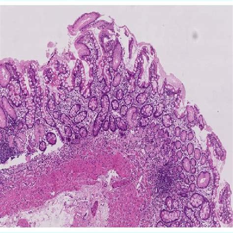 Clinical Picture In Patients With Nodular Lymphoid Hyperplasia 25