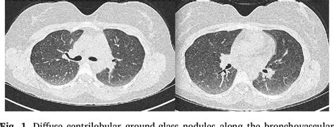 Figure 1 From P Anca Negative Eosinophilic Granulomatosis With