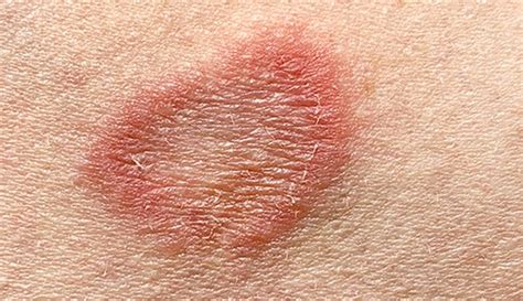Top 10 What Causes Ringworm And How To Treat It 2023