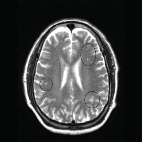 Mri Brain White Matter Abnormalities Mri Scan Images Mri Brain Sexiz Pix