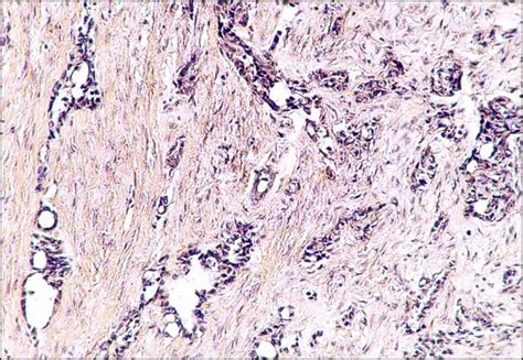 Mesothelioma is a type of cancer that develops from the thin layer of tissue that covers many of the internal organs (known as the mesothelium). Biphasic mesothelioma with epithelial compound of tubular ...
