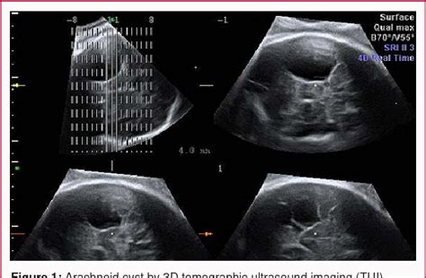 Figure 1 From Three Dimensional Tomographic Ultrasound Imaging 3d Tui